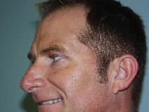 Botulinum toxin after